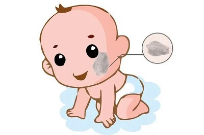 造成太田痣病情反弹的原因找到了，患者收藏！