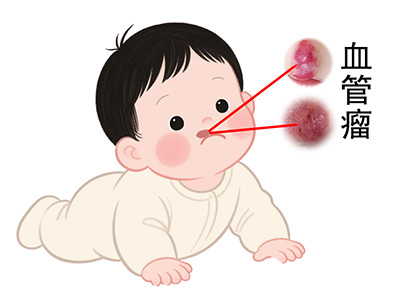 <strong>血管瘤的危害大吗？南京胎记治疗哪家好点？</strong>