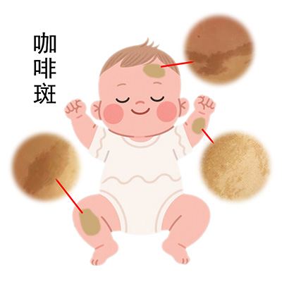 <strong>牛奶咖啡斑有什么危害？南京能够治疗胎记的医院在哪里？</strong>