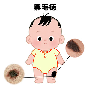<strong>儿童黑毛痣几岁治疗合适？南京哪里治疗胎记效果好？</strong>