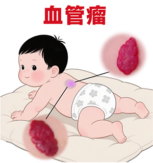 <strong>皮肤问题丨血管瘤是良性肿瘤吗？会自行消退吗？</strong>