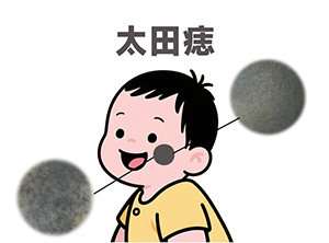 <strong>健康科普：太田痣治疗后多久能戴隐形眼镜？会刺激患处吗？</strong>