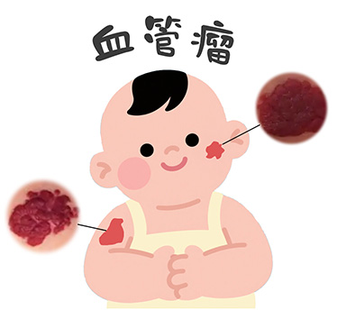 <strong>血管瘤患者日常需要注意什么？如何护理？</strong>