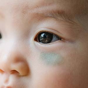 <strong>胎记解析丨太田痣会引发青光眼吗？需要检查眼睛吗？</strong>