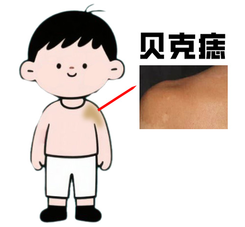 <strong>胎记揭秘：贝克痣会扩散到其他部位吗？速度快吗？</strong>