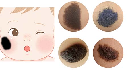 <strong>胎记保健丨黑毛痣会慢慢变大吗？增长速度快吗？</strong>