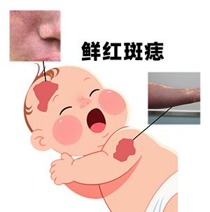 <strong>【健康养护】如何观察鲜红斑痣颜色变化？5个要点</strong>