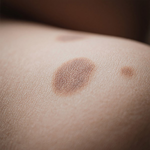 <strong>皮肤知识：咖啡斑术后护理怎么做？三大禁忌事项是什么？</strong>