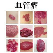 <strong>【肌肤防护】草莓状血管瘤会自己消退？这些情况必须干预！</strong>