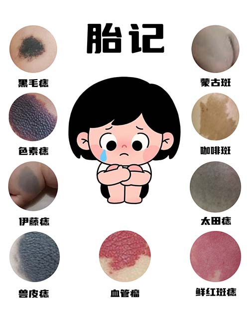 <strong>【皮肤养护】宝宝胎记颜色变深，可能是什么原因？</strong>