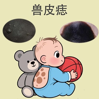 <strong>5岁男宝背部兽皮痣面积扩大？兽皮痣的发展速度</strong>