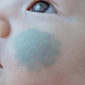 <strong>科普一下丨太田痣不只是胎记，更可能影响眼部健康！</strong>