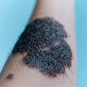 <strong>【误区纠正】黑毛痣长毛就是恶变？别自己吓自己！</strong>