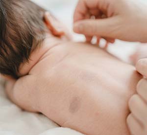 <strong>【治疗选择】宝宝胎记用激光还是药物？怎么选安全？</strong>