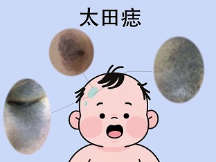 <strong>【健康提醒】太田痣会随年龄越长越深？从出生就注意！</strong>
