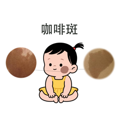【面积发展】宝宝咖啡斑会随年龄增长变大吗？面积增长快吗？