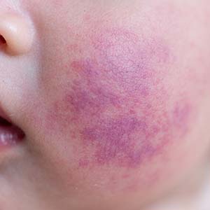 【诊疗科普】鲜红斑痣用激光治疗效果好吗？需要几次？