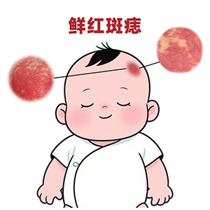 【问答时间】鲜红斑痣能自行消退吗？别被误导了...