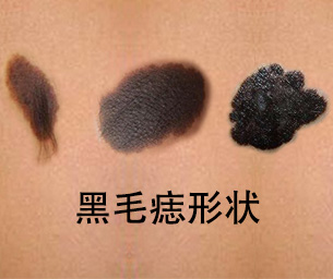 【胎记须识】黑毛痣治疗费用怎么计算？影响因素有这些？