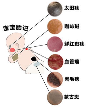 <strong>【新生儿胎记要处理吗？】90%无需干预，但10%需警惕</strong>