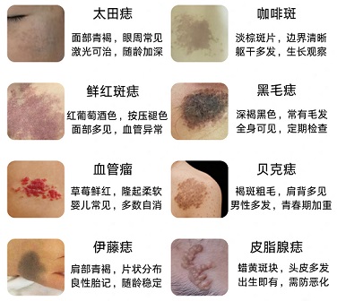 <strong>婴儿胎记会随着年龄变大吗？南京胎记医院哪家好点？</strong>