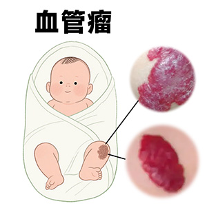 血管瘤初期有什么症状？早期怎么识别？